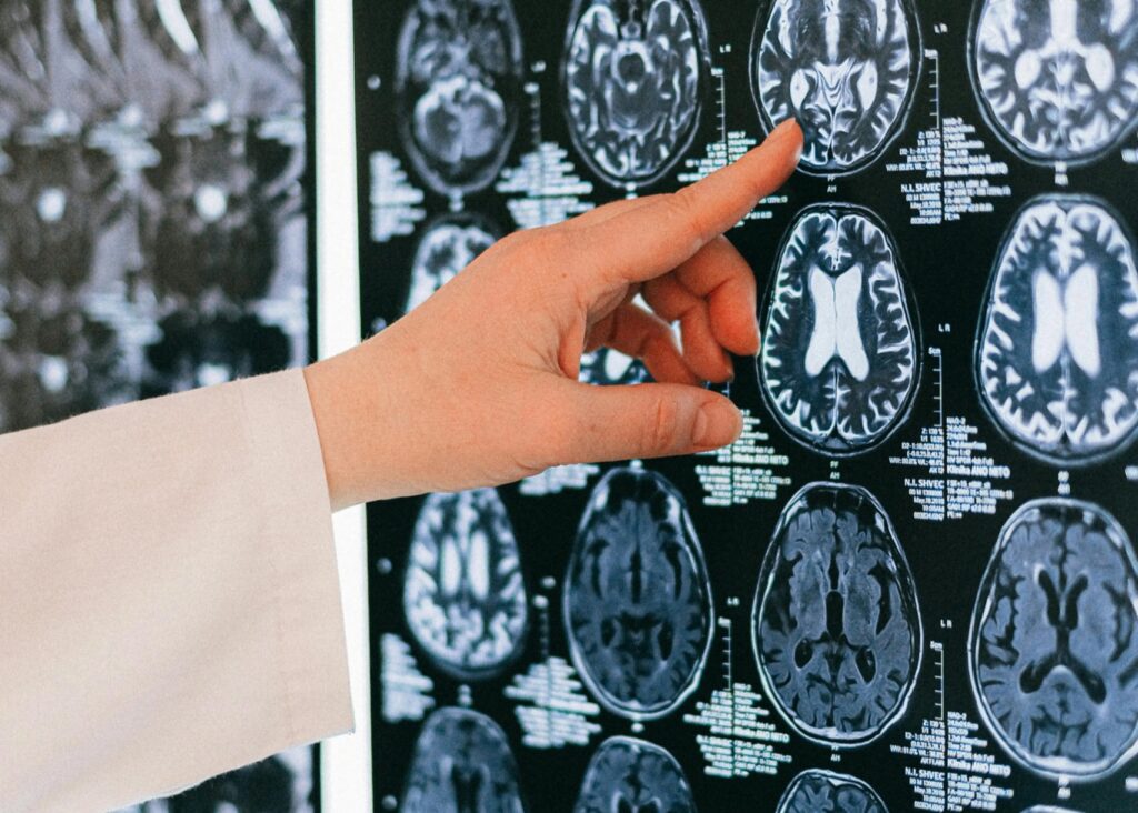 Co je Parkinsonova choroba a dá se léčit?
